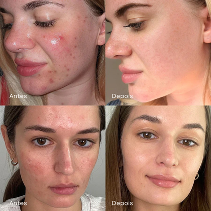 Sérum de Ácido Succínico Vermelho